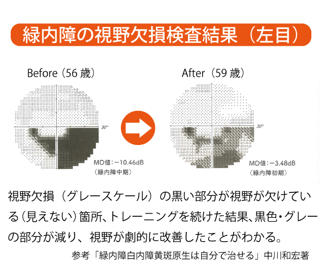 緑内障による視野欠損の、目のトレーニング、ブルーベリーサプリメントやルテインによる改善例　