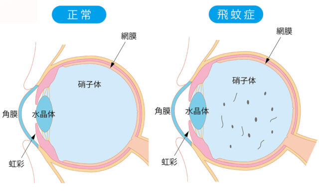 飛蚊症ってどんな見え方？放置して良いの？